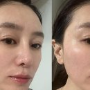 제미안 | 흑자 리팟레이저 알고 선택한 장희빈미안법 후기