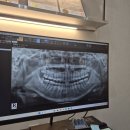 안치과의원 | 대구 잘가요사랑니치과의원, '진짜 안 아픈' 사랑니 발치 후기