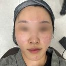 페이스라인 - 청주시 서원구 예체로 81 | 청담피부과 튠페이스 리프팅 리얼 후기 | 턱라인 볼패임 시술 효과