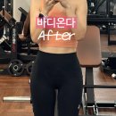 커피온다 | 명동피부과 바디 온다리프팅 후기, 복부 전후 비교