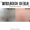 네이쳐포유 | 슴드름 가드름 등드름 제거 바디워시 추천] 블랑네이처 아크네 바디워시 2주만에 사라진 사진 후기 공유