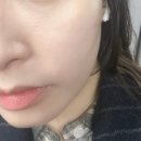 볼륨 | 선릉역피부과 땅콩형얼굴 티베룩 티티늄리프팅 쥬베룩볼륨 후기