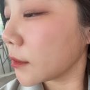 스킨프로 | 청담 피부과, 레드터치프로 + 스킨부스터 내돈내산 후기 콜라겐재생