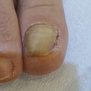 장항약국 | 다쳐서 빠진 무좀발톱,6개월차 전문관리 후기 레푸스 일산장항점