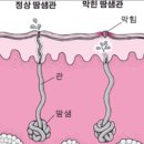 땀띠 치료법. 이미지