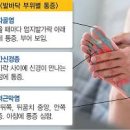 발바닥 앞쪽 통증 원인 발 앞꿈치 앞발바닥 통증 이미지