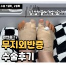 수무지옆들 | 수술 1일차 2일차_러너의 무지외반증 양발 동시수술 후기 척추마취 샤워 냉찜질 물리치료