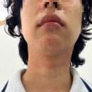 밝은얼굴피부과의원 | 천안 피부과 레이저 제모 추천｜남성 인중·턱·목 제모 효과는? 뷰티라운지 의원 내돈내산 리뷰