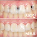 미소현치과의원 | 앞니 심한 충치, 신경치료나 크라운 하지 않고 레진빌드업으로 회복한 증례