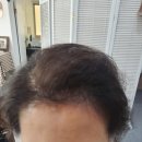 모자티헤어증모
