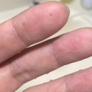 대곡중앙의원 | 신촌_노벨의원 레이저 제모 #2