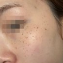[압구정 루나의원] 루비레이저 주근깨 조진 찐 후기@@ 내돈내산ㅣ10개월차 경과 사진ㅣ일주일 딱지 탈각...