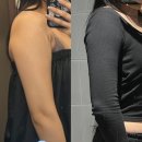 청담쟈스민라인의원 | 청담피부과 사점사의원 팔뚝 지방분해주사 1회차 통증, 가격, 후기