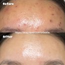 리하스킨케어 | [리하스킨케어] 내돈내산 찐후기 및 전후 사진 | 이수역 • 총신대 입구 • 사당역 서울 여드름 관리