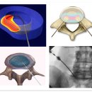 척추디스크수술방법 중 고주파열치료술의 적응 비적응증 이미지