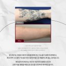 세컨드 웨이 | 문정역피부과, 피코웨이를 이용한 확실한 문신제거 후기 및 원리