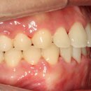 NR-6[경춘로]-하-274 | 치아교정 중심선 맞추기 후기 악궁확장 미니스크류 사용