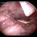 목에 가시 걸렸을때 걸린느낌 생선가시 빼는법 병원가야 할까? 이미지