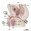 요의와 빈뇨 관련해서. 이미지