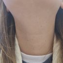 서면한의원 | 부산 서면 한의원 흉터없는 편평사마귀제거 후기