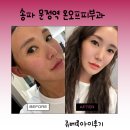 송파 문정역 온오프피부과 눈가주름 쥬베룩아이 후기