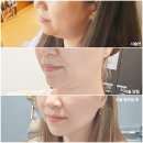 콜릭언니 | 신논현역피부과 온다리프팅 부작용 없는 이중턱살 꿀조합 후기