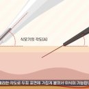 J헤어라인