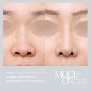 강남대로 511 | 첫코수술 전후비교 | 처진코 매부리코 퍼진코 한 번에 개선 후기