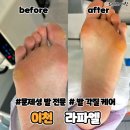 이천 문제성 발 전문 라파엘, 각질케어로 아기발된 후기