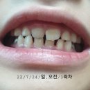 이세현 치과 : 치아교정 치료 후기 : 막대기 막대 스틱 설압자