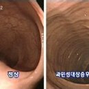 194- 과민성대장증후군 체질한약치료사례 이미지