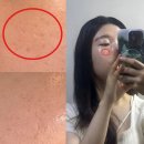 바다한의원 | 여드름 패인흉터 제거 치료 노원 피부과 한의원 새살침 솔직후기