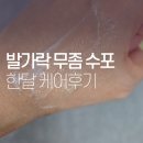 발가락 무좀 수포 한달 케어후기