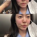 필치과병원 | 서울 포테자 병원 ㅣ 포텐자 찐후기 ㅣ 모공 포텐자 후기