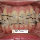 천안치과 성정동치과 / 정호기치과 교정 일기 2