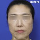 동양미인의원 | 50대실리프팅 후기, 실이 피부 속으로 들어간다고요?