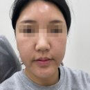 부스터서울 | [서울] 노원피부과 '엘라비에 리투오' 스킨부스터 후기