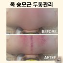 라피움 | 서재스킨케어 라피움 목 승모근 두통관리 후기