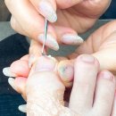 네일지몽 | 별내내성발톱 별내파고드는발톱 교정 네일지몽