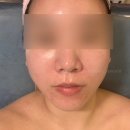 하늘나비 스킨앤바디 | 수원윤곽관리 나비 스킨앤바디 작은얼굴윤곽 앞데콜 받은 후기