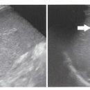 hemangioma 이미지