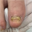미엘네일닥터아이티엔범계지점 | 범계무좀발톱 미엘네일 닥터아이티엔 범계지점에서 해결