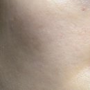 선맥씨라인한의원 | 포텐자 내돈내산후기 포텐자 다운타임 일주일기록 포텐자 솔직후기