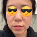 뉘앙스성형외과의원 | 수원 점빼기 얼굴 한 판 가격 10만원 기록(점, 흑자, 비립종)