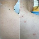 청라한내로21, 해원중학교 앞 | 디어브로우 청라점에서 편평사마귀와 쥐젖 잡티 제거 받은 찐 후기