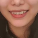 아무도모르게 3개월이면 끝나는 &lt; #미니셀교정 &gt; 잠실치과 모나리자치과 잠실역치과