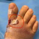 은진탕 | [무지외반증 수술 후기] 비용, 통증, 회복 기간, 보험까지! 재수술까지 한 무지외반수술 3번한 사람의...