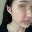 양천한의원 | 양천구 세연한의원에서 얼굴, 목 편평사마귀 제거 8~13일차 후기