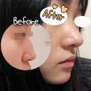 늑연골코수술 후 안장코 개선! (무보형물코수술)