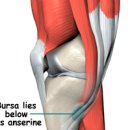 무릎 안쪽 통증 거위발건염 원인 증상 치료 이미지